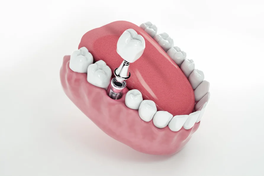Dental implants after tooth loss