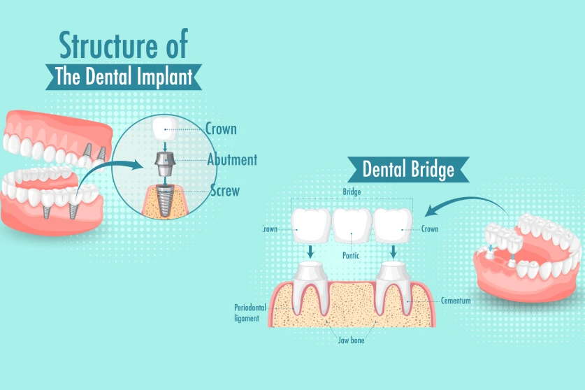 Dental implants vs dental bridge