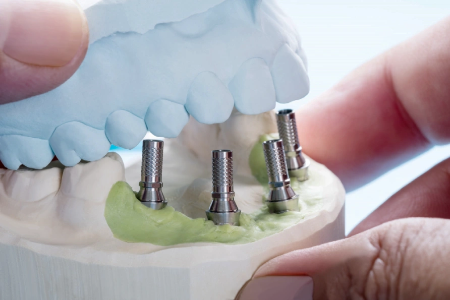 Dental implants - alternative to dentures