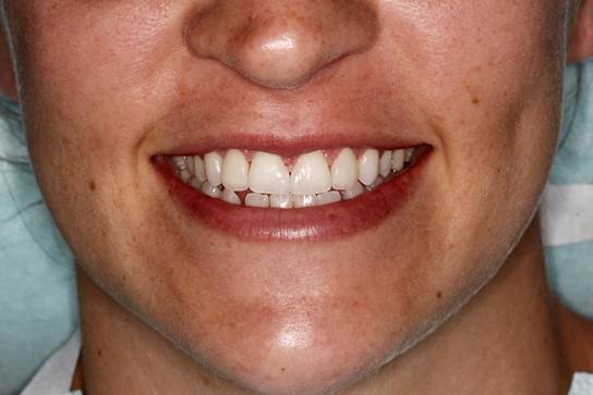 Smile after treatment with porcelain veneers – natural result without spacing