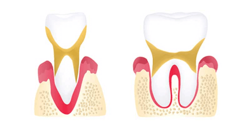 periodontal disease stage 3 - advanced periodontitis