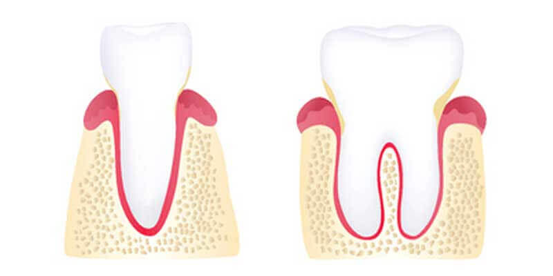 periodontal disease stage 1 - gingivitis