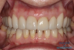 After esthetic restorative dentistry with all ceramic crowns and porcelain veneers