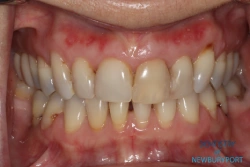 Before esthetic restorative dentistry with all ceramic crowns and porcelain veneers