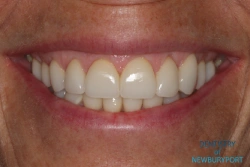 After full mouth rehabilitation with porcelain veneers, crowns, and implants