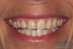 Before full mouth rehabilitation with porcelain veneers, crowns, and implants