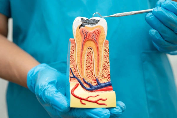 Cross-section of a tooth showing infection reaching the pulp during root canal treatment
