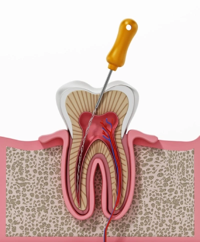 root canal treatment process